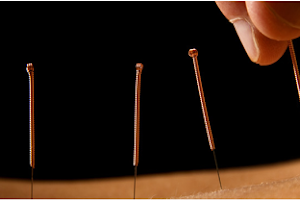 Anmian Acupuncture image