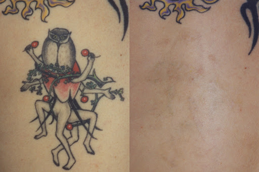 Explore whitetail deer tattoo ideas, creative tattoo ideas in Washington, available at Center For Laser Surgery