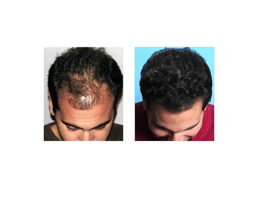 Bosley - Hair Restoration & Transplant - Miami
