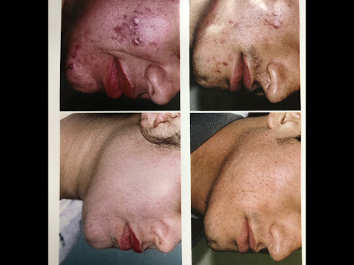 Explore soldier tattoos ideas, creative tattoo ideas in Victorville, available at Goawaytats tattoo removal