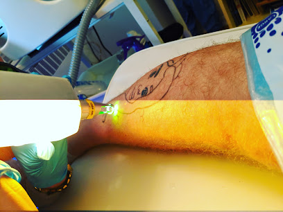 Pure FX Laser Tattoo Removal