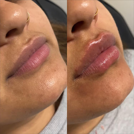 Diamond Beauty And Aesthetics | Lip Fillers | Anti Wrinkle Treatments | Fat Dissolving