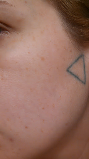 Signature Laser Tattoo Removal - Nashville