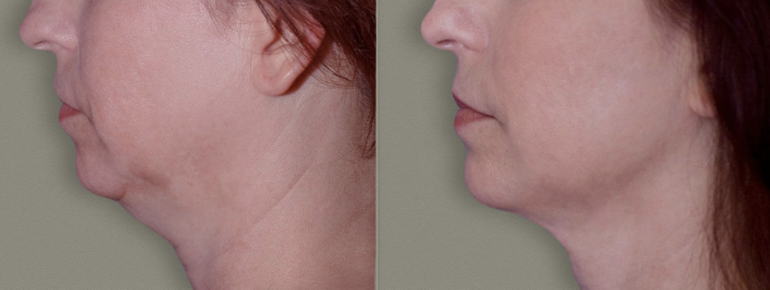 Athenix Body Sculpting Institute - Portland - Athenix Body Sculpting Institute - Portland