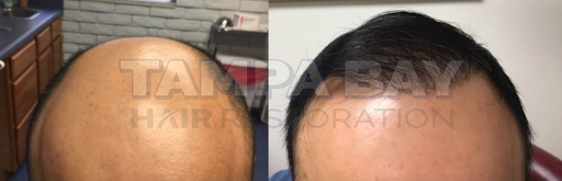 Hair Replacement Service «Tampa Bay Hair Restoration», reviews and photos, 1266 Turner St b, Clearwater, FL 33756, USA