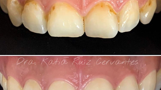 Implantes Dentales Morelia CÉNIT Odontología Avanzada | Dentistas en Morelia | Diseño de Sonrisa