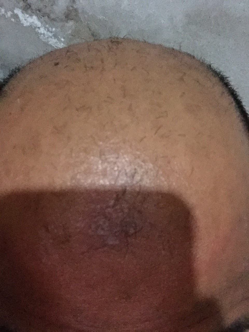 Hair Transplant Clinic