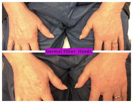 Explore birthmark tattoo ideas, creative tattoo ideas in Lake Oswego, available at Lake Oswego Vein and Aesthetic LOVA