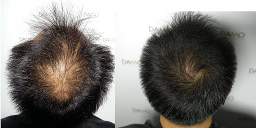 엘에이 탈모전문 클리닉 DAMO Hair Loss Solution