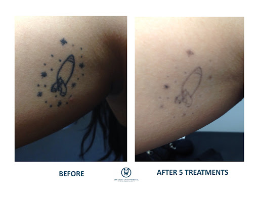 Explore allen iverson tattoo ideas, creative tattoo ideas in San Diego, available at Removery Tattoo Removal & Fading