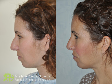 Afshin Yousefpour جراح تجميل الوجه - Afshin Yousefpour Facial Plastic Surgeon