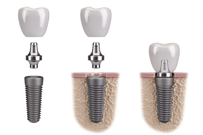 Clínica dental en Comas | Clínica dental Odonthopolis | Brackets - Comas