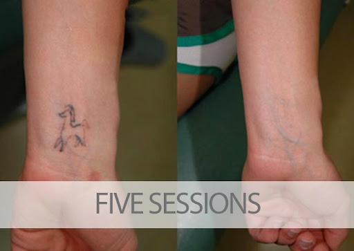 Explore lumalee tattoo ideas, creative tattoo ideas in Palm Harbor, available at EradiTatt Tattoo Removal of Palm HarborClearwater