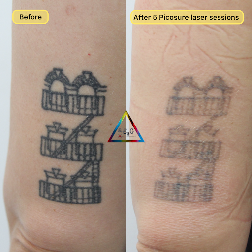 Explore autism tattoos ideas, creative tattoo ideas in New York, available at Ag2g Laser Tattoo Removal & MedSpa