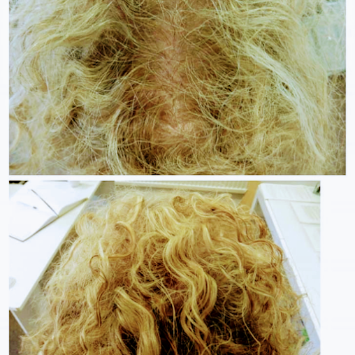 عيادات تساقط الشعر - كارلايل - The Hair Loss Clinics - Carlisle