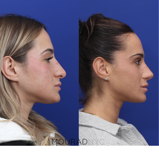 Moustafa Mourad, MD | Rhinoplasty NYC