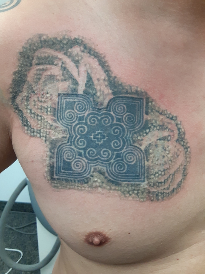 Fearless Tattoo Removal