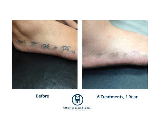 Explore milwaukee tattoo ideas, creative tattoo ideas in San Diego, available at Removery Tattoo Removal & Fading