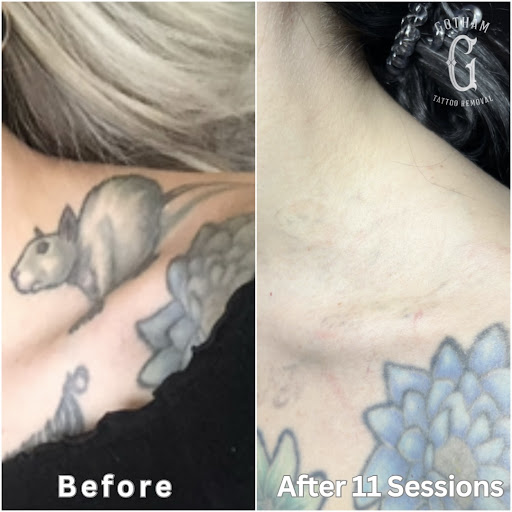 Explore qr code tattoo ideas, creative tattoo ideas in Brooklyn, available at Gotham Tattoo Removal