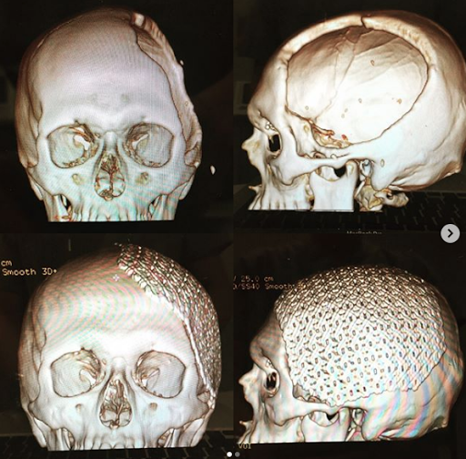 ☘️ Neurocirugía/ Cirugía de Columna en León. Dr. Esteban Reyes Velasco