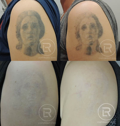 Explore cover up tattoos ideas forearm, creative tattoo ideas in Rochester, available at Renewal Laser Clinic