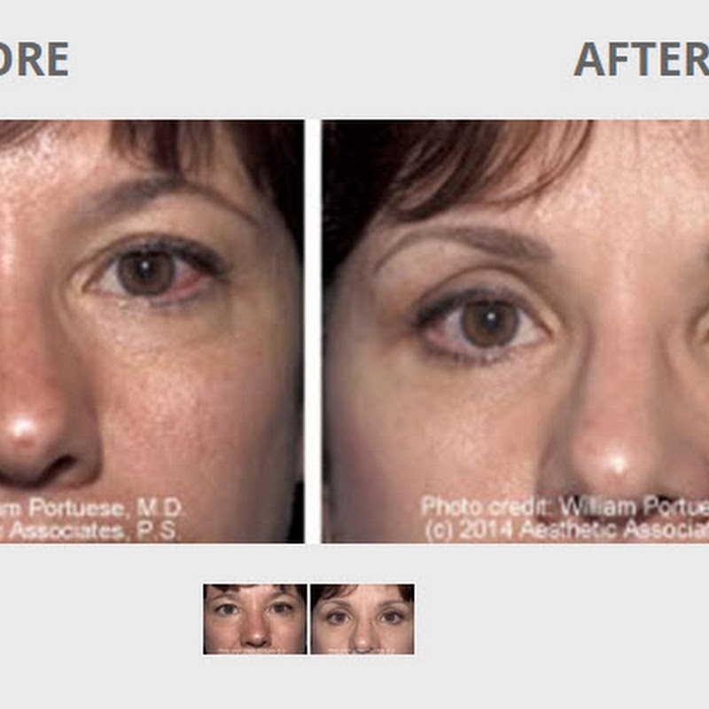 The Seattle Eyelid & Blepharoplasty Center