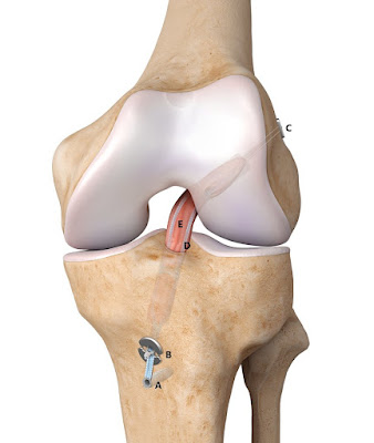 Chirurgien Orthopédiste Clichy - Dr Tristan DUGUAY - Ligamentoplastie de genou et cheville / Prothèses / Hallux Valgus à Clichy