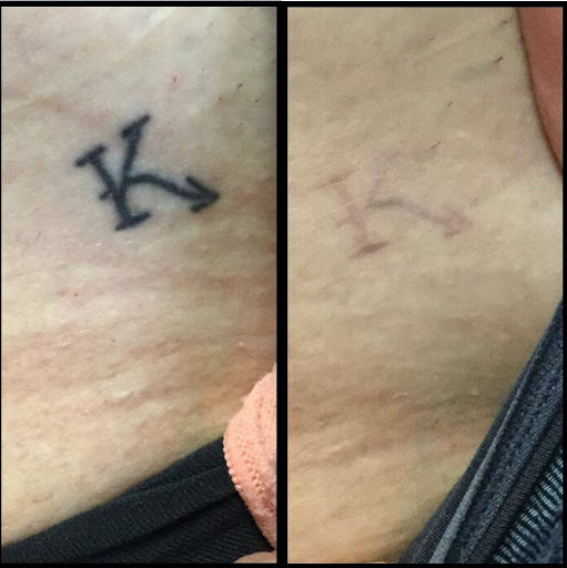 Explore wrist butterfly tattoo ideas, creative tattoo ideas in Hermosa Beach, available at Removery Tattoo Removal & Fading
