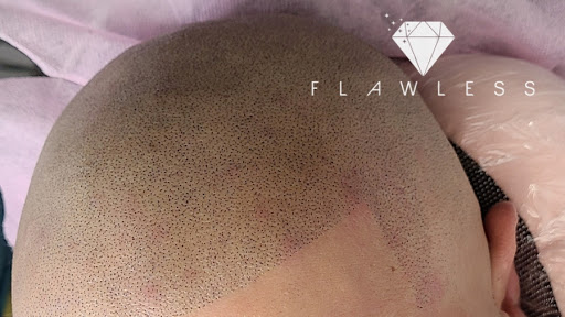 Flawless Scalp - Vancouver Scalp Micropigmentation