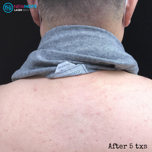 Explore german tattoo ideas for guys, creative tattoo ideas in Westminster, available at Newhope Laser Skin Care