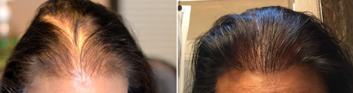 Hair Replacement Service «Advanced Hair Restoration», reviews and photos, 10655 NE 4th St #310, Bellevue, WA 98004, USA