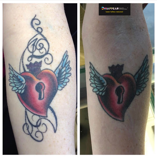 Explore women's arm tattoo ideas, creative tattoo ideas in Lawrence, available at Removery Tattoo Removal & Fading