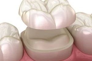 DC Dental Barrière image