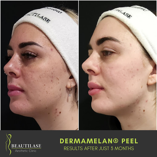 Beautilase - Beautilase