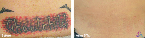 Explore snowboard tattoo ideas, creative tattoo ideas in Fort Myers, available at Laser Tattoo Removal by Tatt Cemetery