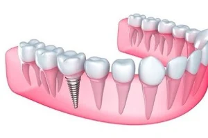 Dr Naser Sharifi Implant Dentistry image