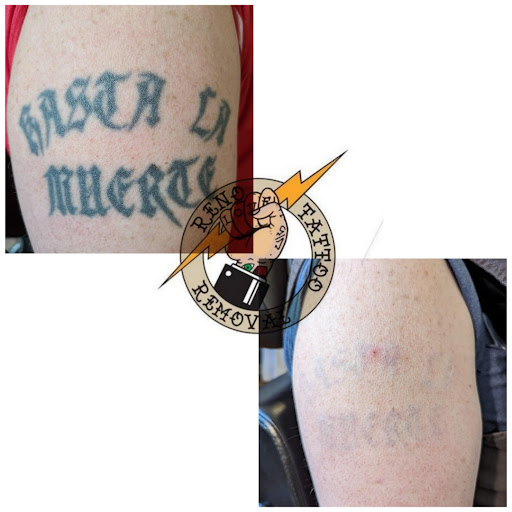 Explore my sister's keeper tattoo ideas, creative tattoo ideas in Reno, available at Reno Tattoo Removal