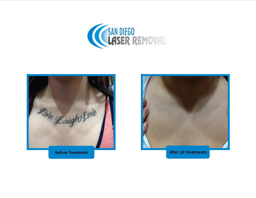 Explore tattoo ideas for family symbol, creative tattoo ideas in San Diego, available at Removery Tattoo Removal & Fading