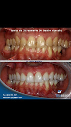 Oral Design - Dr. Danilo Monteiro - Odontologia Estética - lentes de contato dental - implantes dentários - alinhadores invisíveis - gengivoplastia
