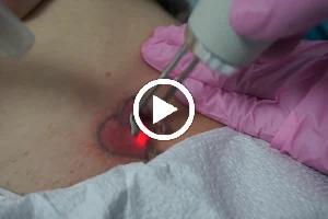 MD Laser Tattoo Removal Baltimore image