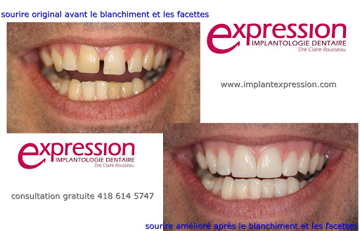 Implantologie Dentaire Expression