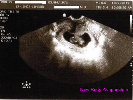 New Body Acupuncture image