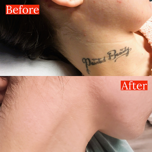 Explore floral tattoo cover up ideas, creative tattoo ideas in Rochester, available at Rochester Tattoo Removal