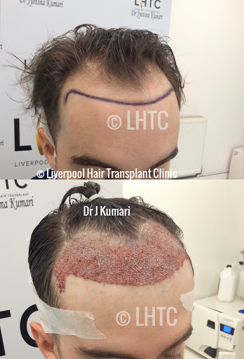 Liverpool Hair Transplant Clinic