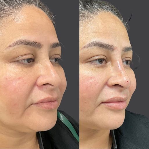 Explore netherlands tattoo ideas, creative tattoo ideas in Whittier, available at Skin Perfect Medical Aesthetics