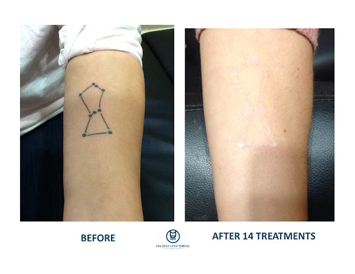 Explore alzheimer's tattoo ideas, creative tattoo ideas in San Diego, available at Removery Tattoo Removal & Fading