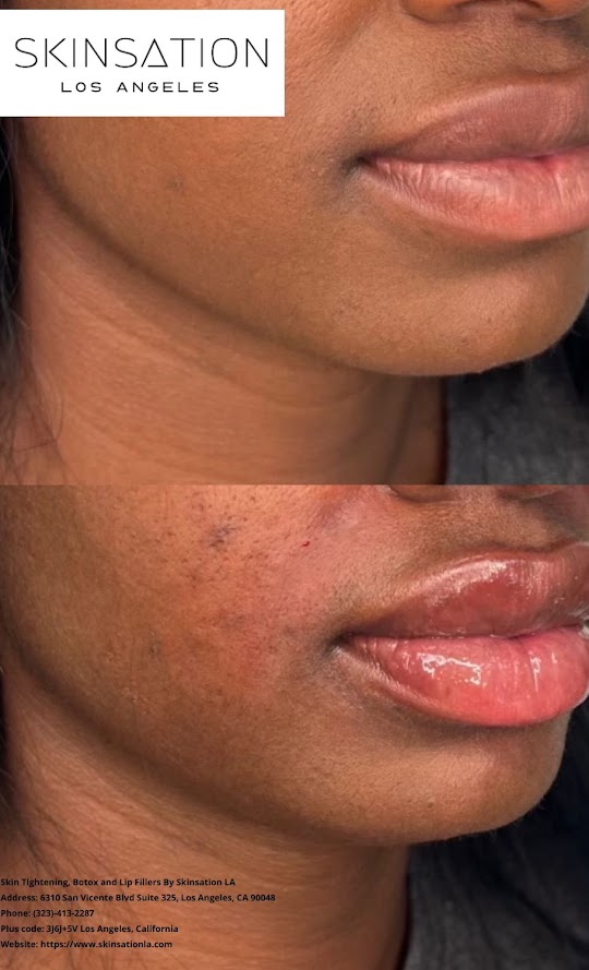 Lip augmentation injections in West Hollywood thumbnail