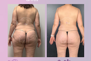 Belleza Colombiana | Body Contouring + Post Op Care/Rehab (Lymphatic drainage) image