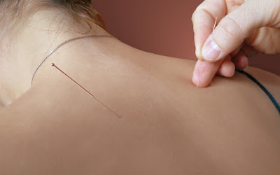 Mathieu Renault - Cabinet de médecine chinoise (acupuncture, tuina, pharmacopée) à Sartrouville