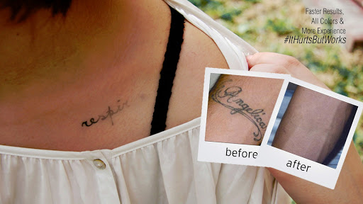 EradiTatt Tattoo Removal of Tampa